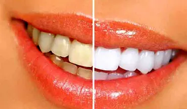 با دندان های زردمان چه کنیم؟ | چند روش خانگی برای از بین بردن زردی دندان‌ها 