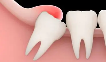 دندان عقل فایده ای هم دارد؟