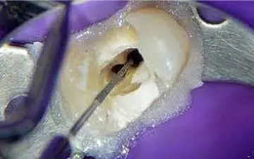 هر آنچه باید درخصوص عصب‌کشی دندان‌ها بدانید