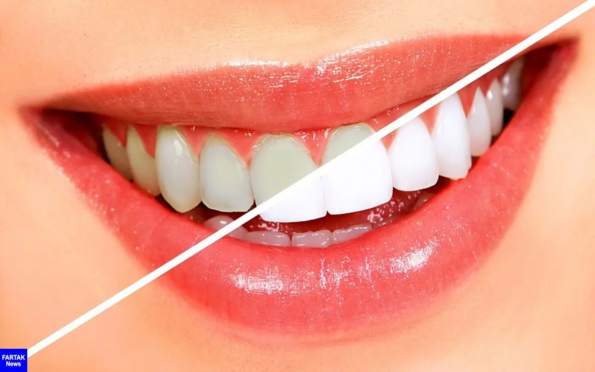 جرم گیری دندان بدون نیاز به کلینیک