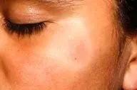 لکه سفید روی پوست کودکان نشانه چیست؟