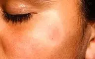 لکه سفید روی پوست کودکان نشانه چیست؟