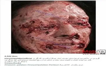 تصویری دلخراش از اسیدپاشی روی صورت خانم بازیگر!