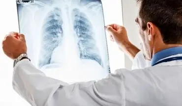 بیماری‌هایی که ریه‌هایتان را هدف قرار داده‌اند