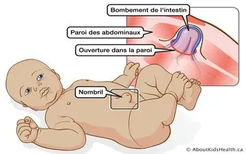 فتق ناف چه زمانی برطرف می شود؟