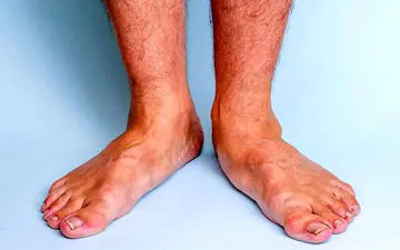 علائم صافی کف پا از چه سنی اتفاق می افتد/ راه‌های درمان+عکس و فیلم 