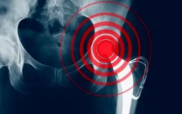 شکستگی ناشی از پوکی استخوان در کمین مردان و زنان بالای ۵۰ سال