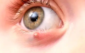 علت ابتلا به گل مژه چیست و چگونه درمان میشود؟