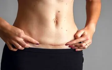 زخم‌های ناشی از سزارین چگونه بهبود می‌یابند؟
