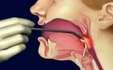 استعمال دخانیات؛ عامل اصلی ابتلای افراد به سرطان حنجره