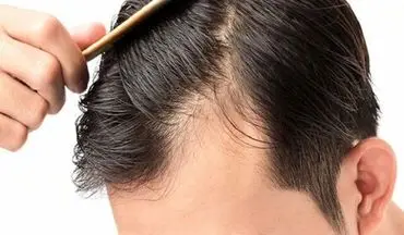 ریزش مو چه موقع غیرطبیعی است؟

