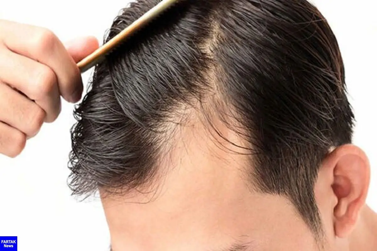 ریزش مو چه موقع غیرطبیعی است؟

