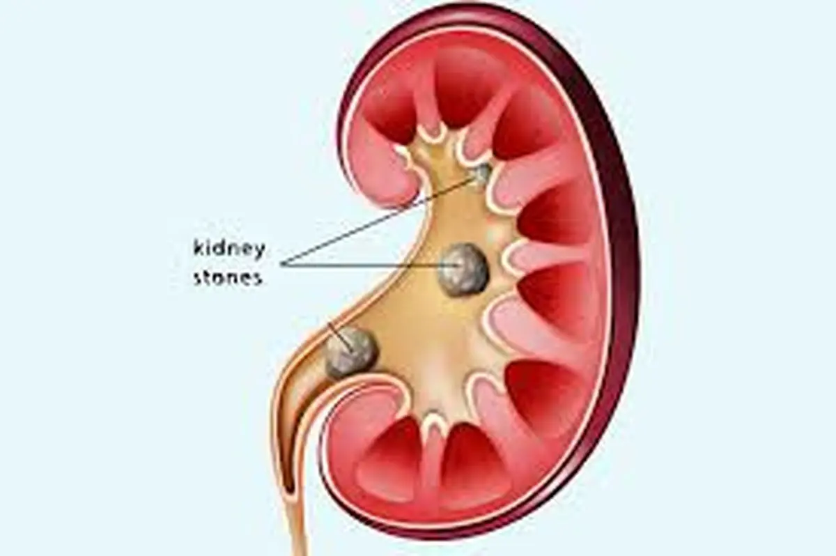 چرا مشکل سنگ کلیه در زمستان بیشتر می‌شود؟
