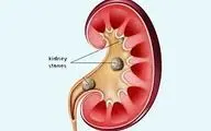 چرا مشکل سنگ کلیه در زمستان بیشتر می‌شود؟