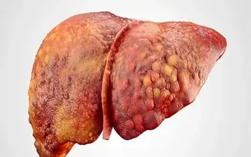 عواملی که باعث ایجاد کبد چرب می شوند