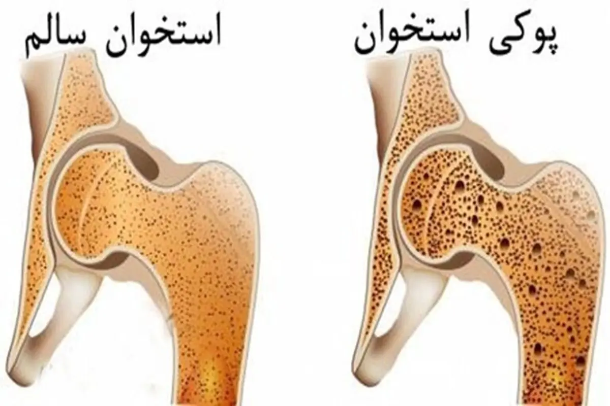 پوکی استخوان در این شرایط قابل درمان است