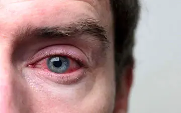  بلفاریت چشم چیست و چه علائمی دارد؟ 