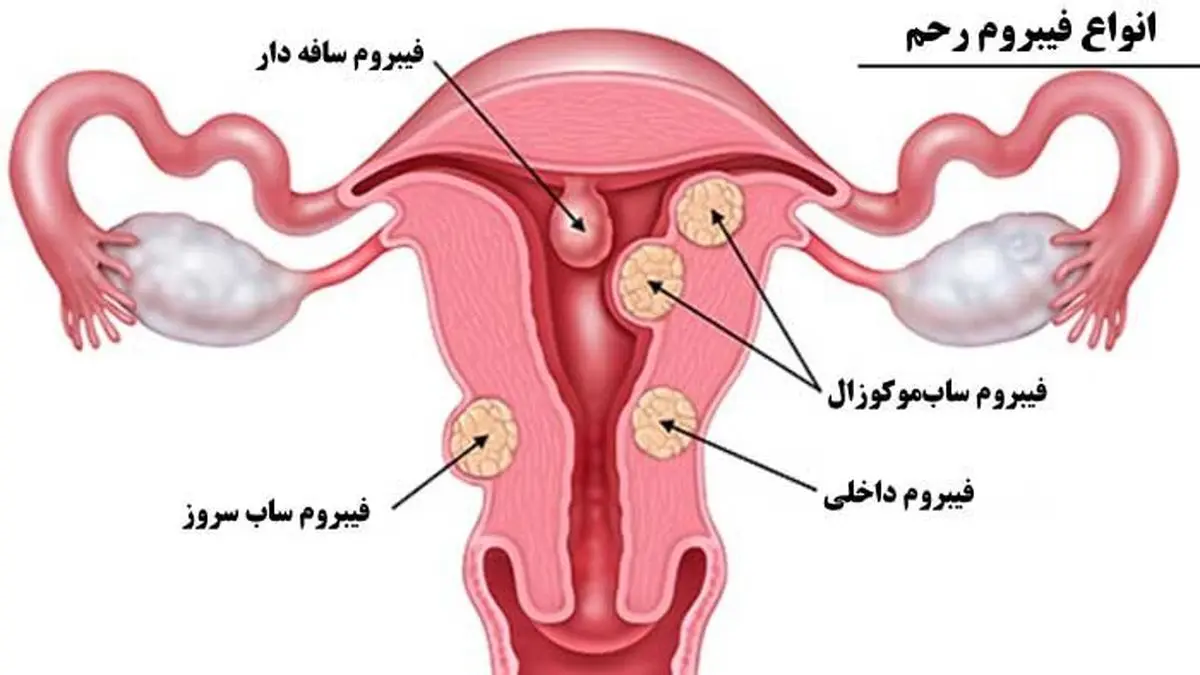 ایجاد فیبروم به چه علت است؟