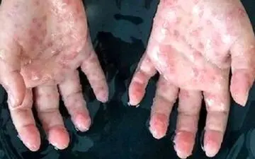 مراقبت مرزی برای مقابله با آبله میمون