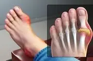 هشدار | به این علائم توجه کنید اینها نشانه نقرس هستند!