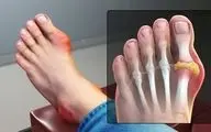 هشدار | به این علائم توجه کنید اینها نشانه نقرس هستند!