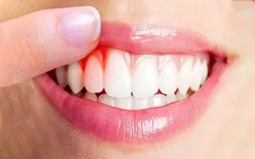 راه‌های مقابله با عفونت لثه