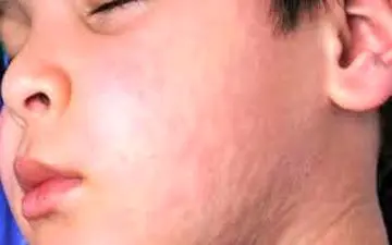 در حساسیت‌های پوستی،بهترین کار چه کاریست؟! 