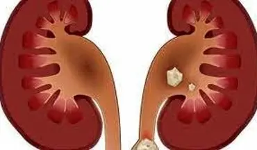 این افراد بیشتر به سنگ کلیه مبتلا می‌شوند