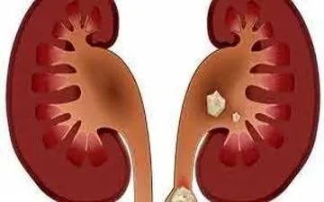 این افراد بیشتر به سنگ کلیه مبتلا می‌شوند