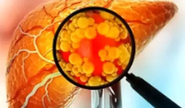 آیا میوه هم باعث کبد چرب می شود؟