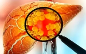 آیا میوه هم باعث کبد چرب می شود؟