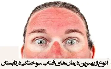 10 نوع از بهترین درمان‌های آفتاب سوختگی در تابستان