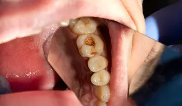 این مواد غذایی از پوسیدگی دندان پیشگیری می کنند