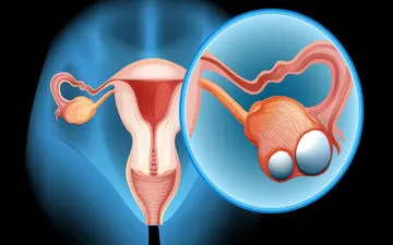 از کجا بفهمیم کیست تخمدان داریم؟ ۶ نشانه هشداردهنده