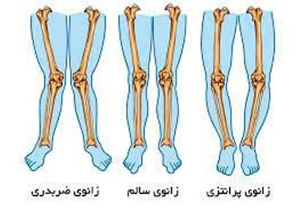 حرکات ورزشی مناسب برای درمان پای پرانتزی بزرگسالان!