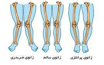 حرکات ورزشی مناسب برای درمان پای پرانتزی بزرگسالان!