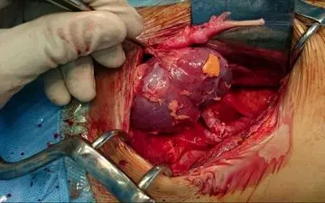 نظام پزشکی: کلیه بیمار اصفهانی سر جایش نبود!