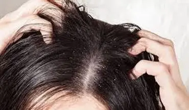 چرا با وجود چربی کف سر اما ساقه موها  همچنان خشک و شکننده است؟