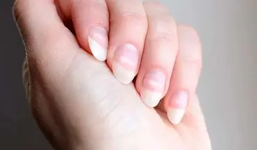 لکه‌های سفید روی ناخن‌ها: از کمبود ویتامین تا علل جدی‌تر