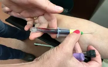 تشخیص آلزایمر با آزمایش خون