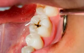 عفونت دندانی و خطر سکته مغزی

