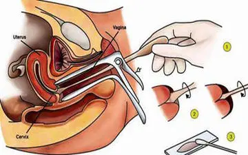 روشهای درمان زخم دهانه ی رحم