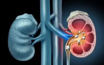 بهترین روش درمان سنگ کلیه چیست؟