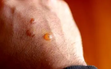 چگونه می شود تاول را درمان کنیم؟