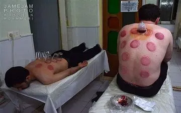  حجامت سرطان را درمان می کند؟!/ هشدار درباره حجامت های زیر زمینی