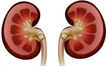 روش های مختلف برای درمان سنگ کلیه