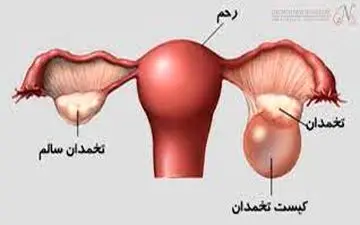 کیست تخمدان| آیا کیست‌های تخمدانی علائم خاصی دارند؟