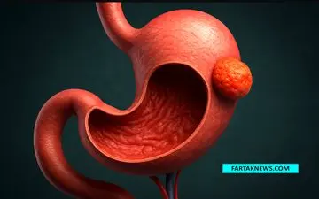 تومورهای GIST معده؛ تومورهای نادری که از سلول‌های گوارشی منشأ می‌گیرند