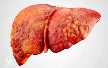 علائم کبد چرب و راه درمان|حساسیت تشخیصی بیماری کبد چرب