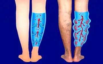 این علائم را دست‌کم نگیرید! ممکن است نشانه نارسایی وریدی باشند